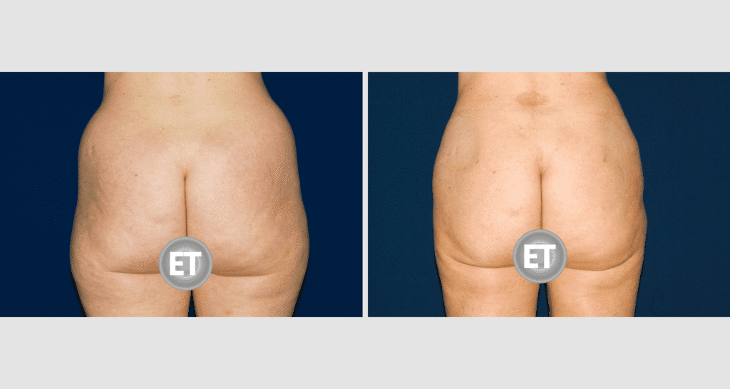 Vorher/Nachher Ergebnis: Fettabsaugung Bauch Huefte