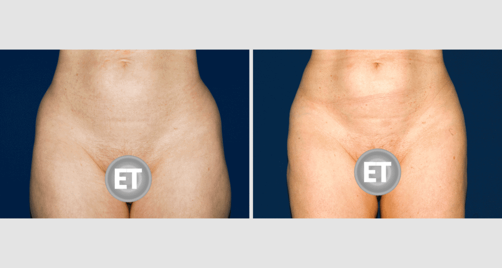 Vorher/Nachher Ergebnis: Fettabsaugung Bauch Huefte