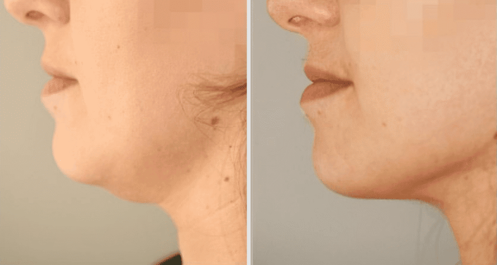 Vorher/Nachher Ergebnis: Fettabsaugung Kinn