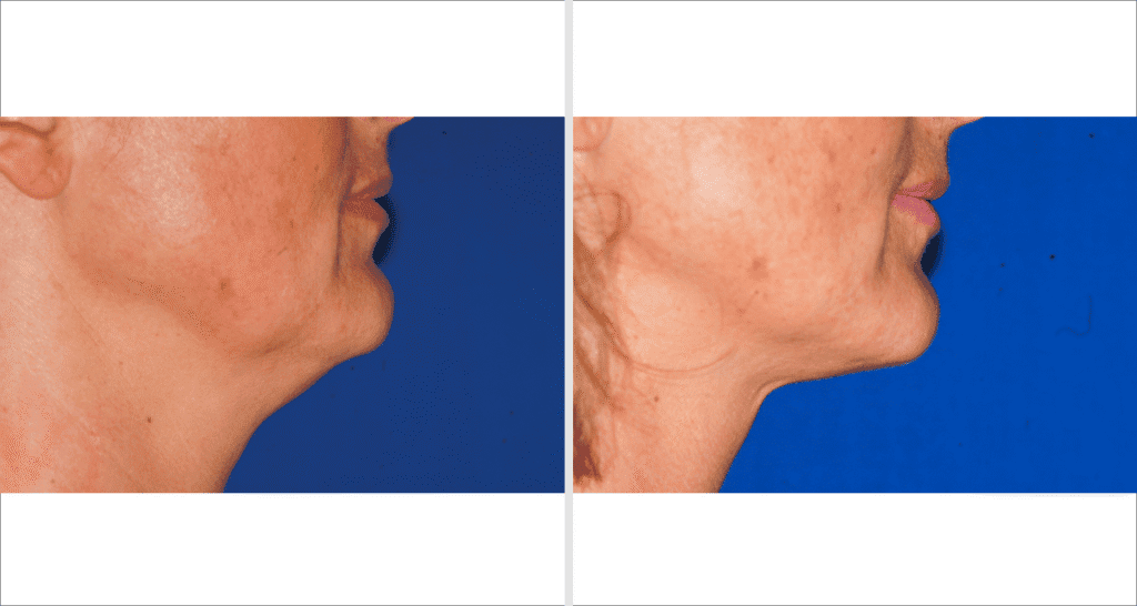 Vorher/Nachher Ergebnis: Fettabsaugung Kinn
