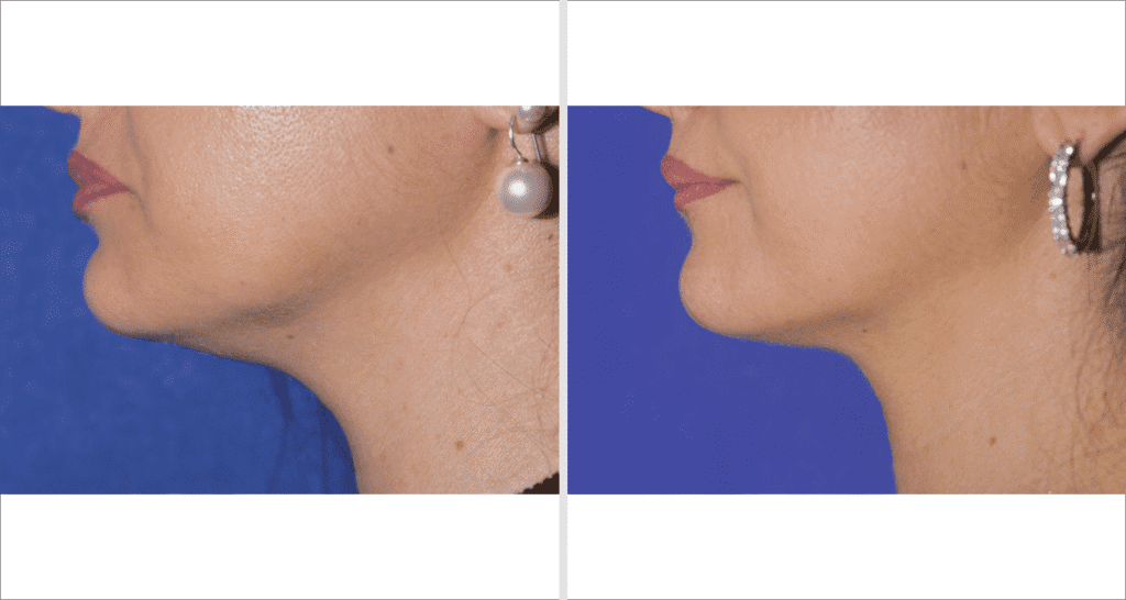 Vorher/Nachher Ergebnis: Fettabsaugung Kinn