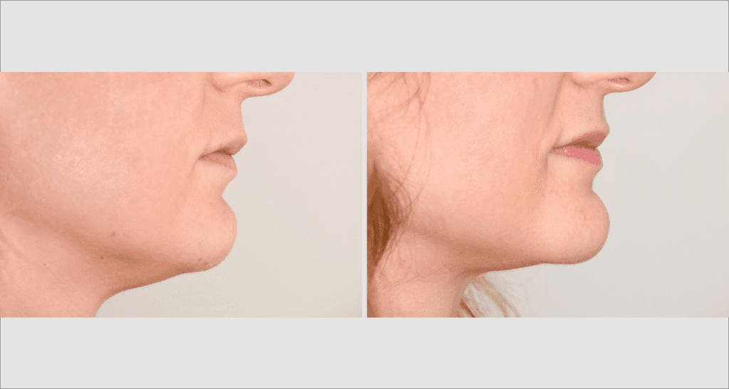 Vorher/Nachher Ergebnis: Fettabsaugung Kinn