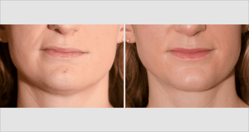 Vorher/Nachher Ergebnis: Fettabsaugung Kinn