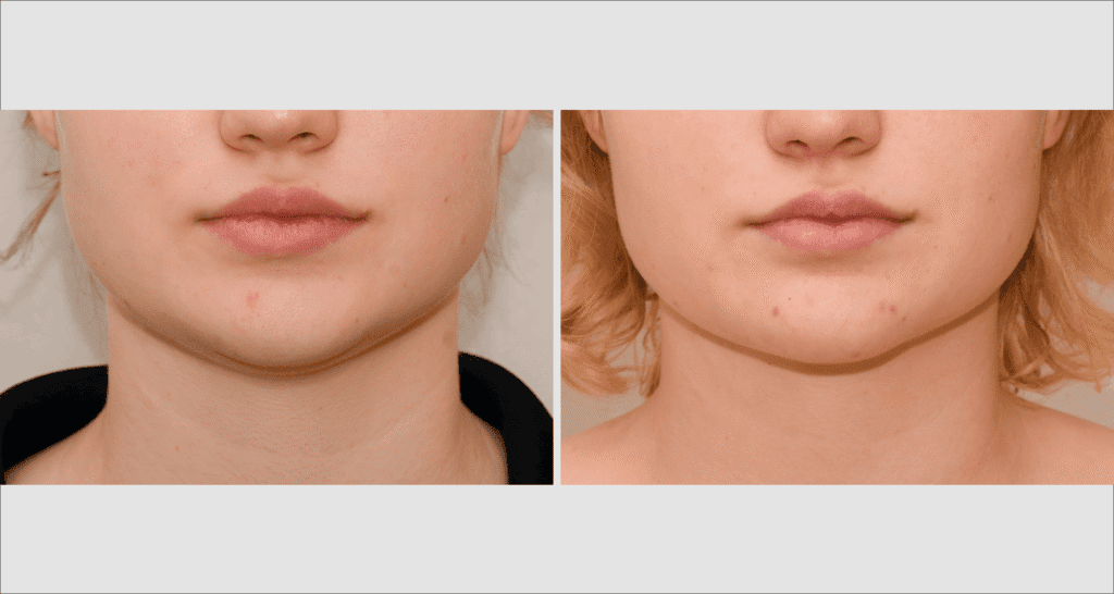 Vorher/Nachher Ergebnis: Fettabsaugung Kinn