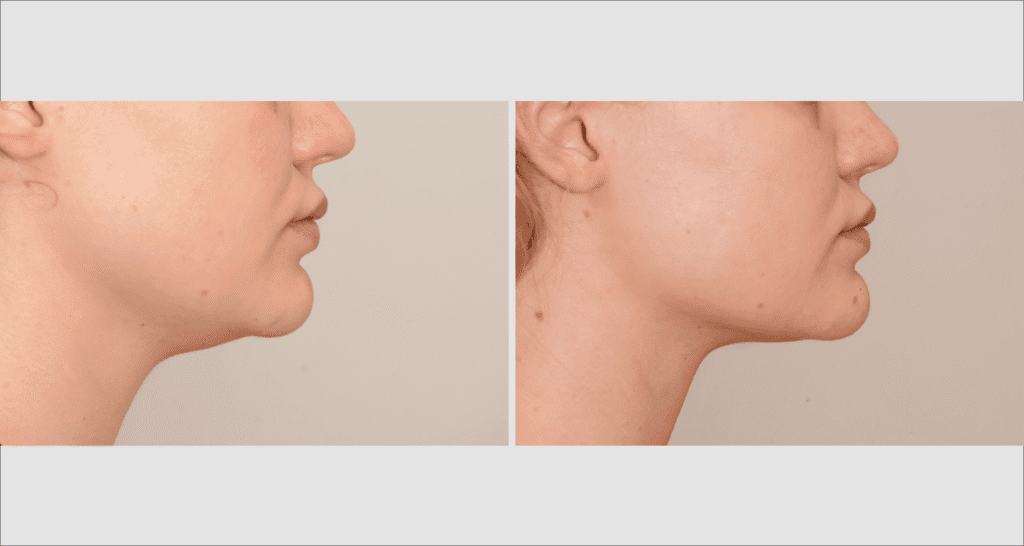 Vorher/Nachher Ergebnis: Fettabsaugung Kinn