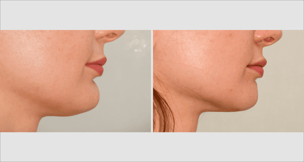 Vorher/Nachher Ergebnis: Fettabsaugung Kinn