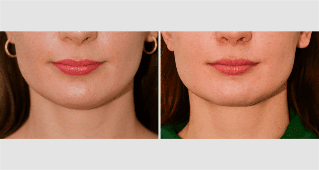 Vorher/Nachher Ergebnis: Fettabsaugung Kinn