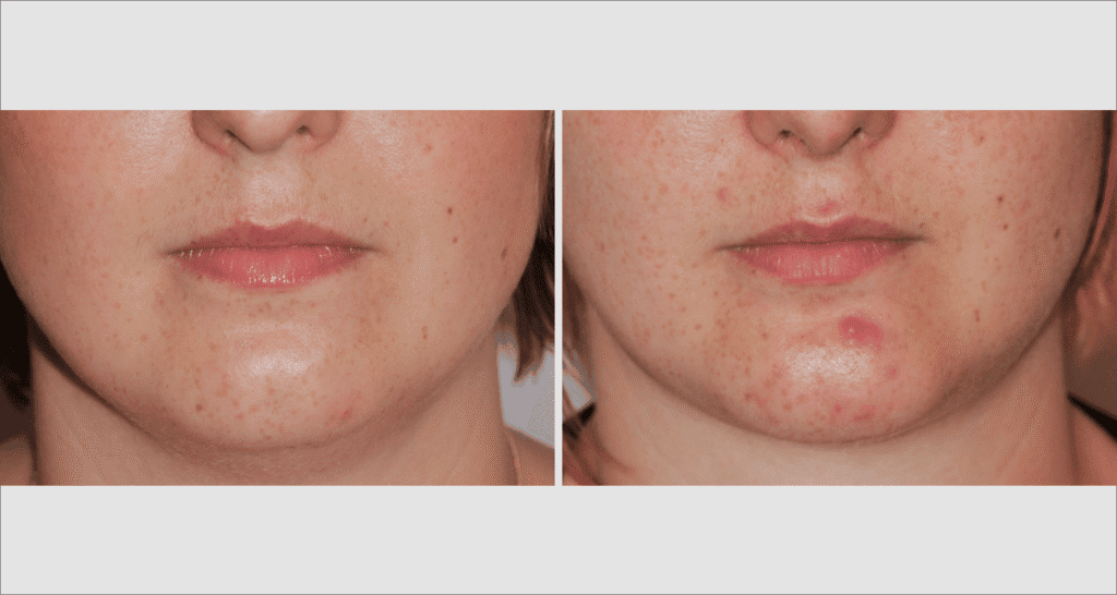 Vorher/Nachher Ergebnis: Fettabsaugung Kinn