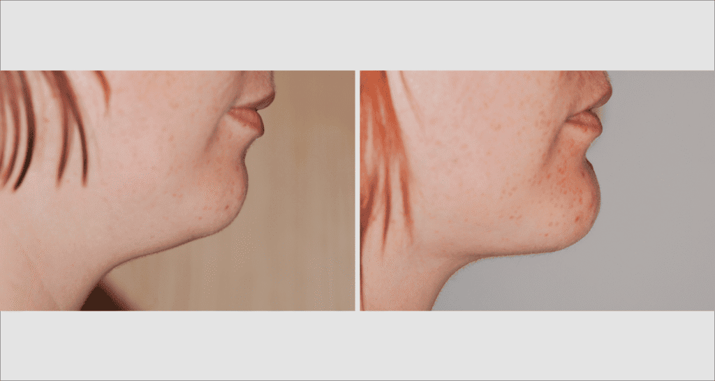 Vorher/Nachher Ergebnis: Fettabsaugung Kinn