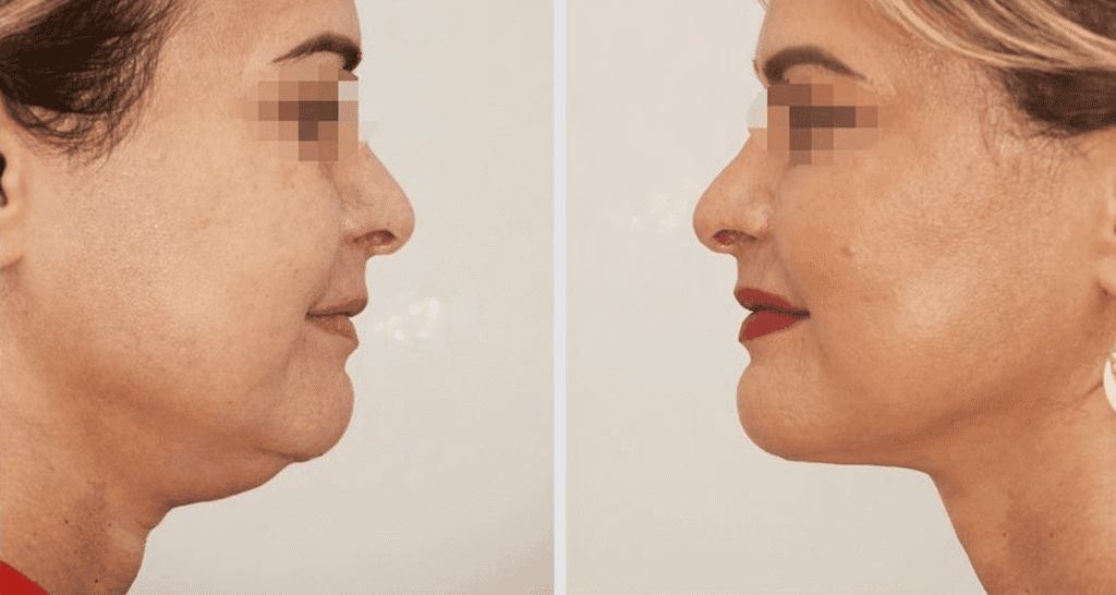 Vorher/Nachher Ergebnis: Fettabsaugung Kinn