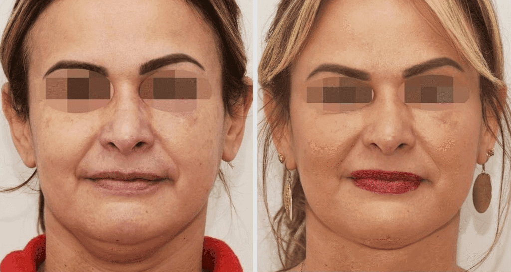 Vorher/Nachher Ergebnis: Fettabsaugung Kinn