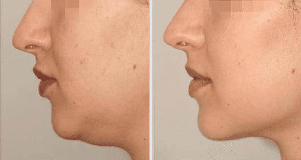 Vorher/Nachher Ergebnis: Fettabsaugung Kinn