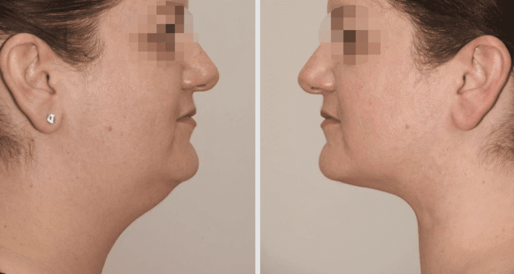 Vorher/Nachher Ergebnis: Fettabsaugung Kinn