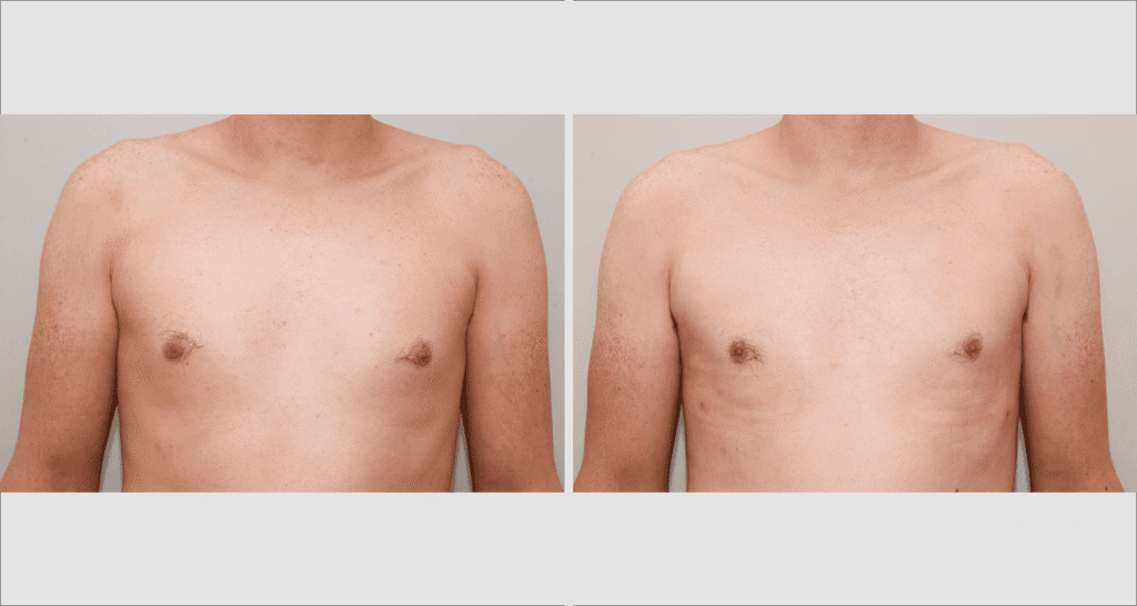 Vorher/Nachher Ergebnis: Fettabsaugung Lipomastie