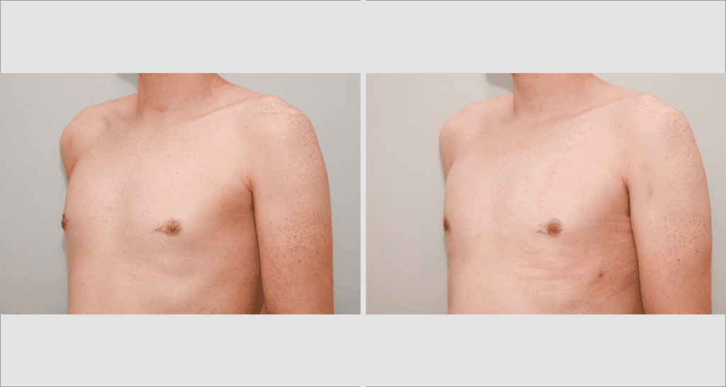 Vorher/Nachher Ergebnis: Fettabsaugung Lipomastie