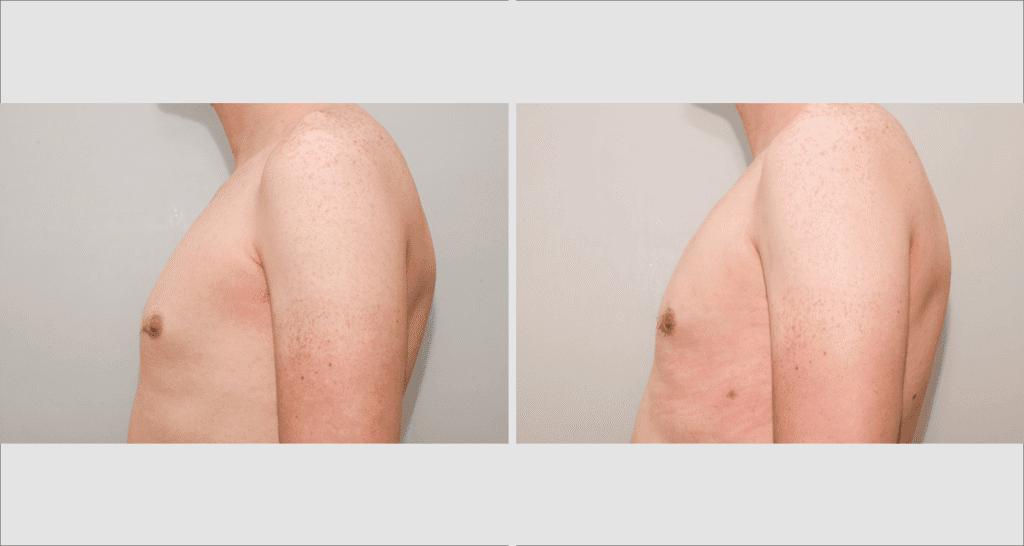 Vorher/Nachher Ergebnis: Fettabsaugung Lipomastie