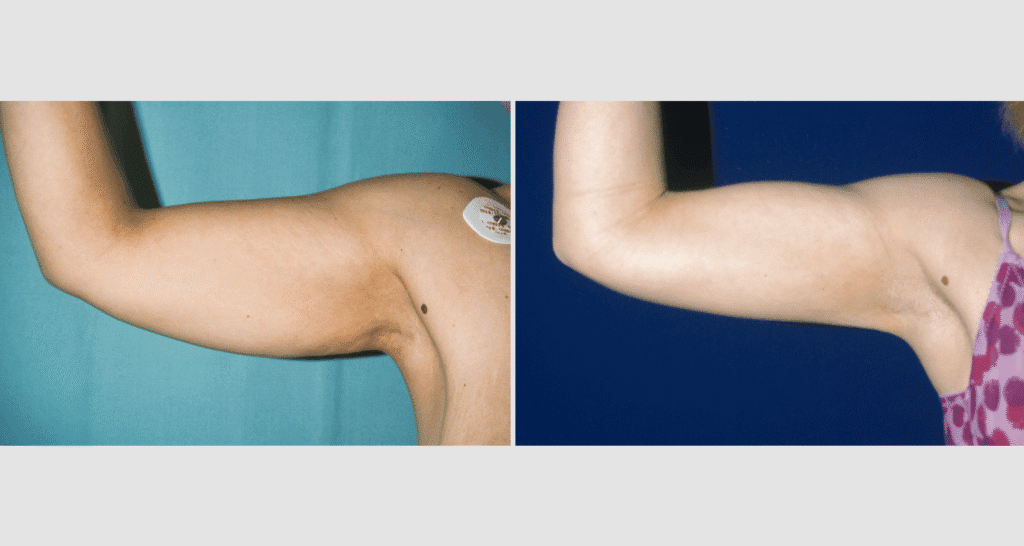 Vorher/Nachher Ergebnis: Fettabsaugung Oberarme