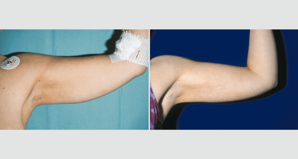 Vorher/Nachher Ergebnis: Fettabsaugung Oberarme