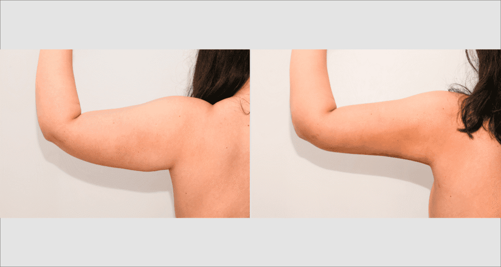 Vorher-Nachher Vergleich einer Fettabsaugung am Arm.