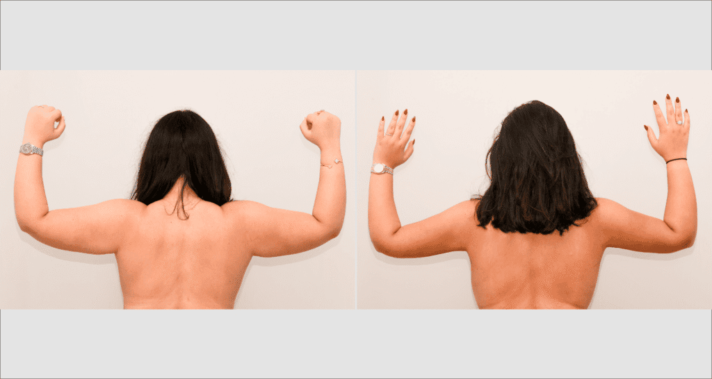 Vorher/Nachher Ergebnis: Fettabsaugung Oberarme