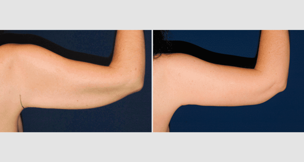 Vorher/Nachher Ergebnis: Fettabsaugung Oberarme