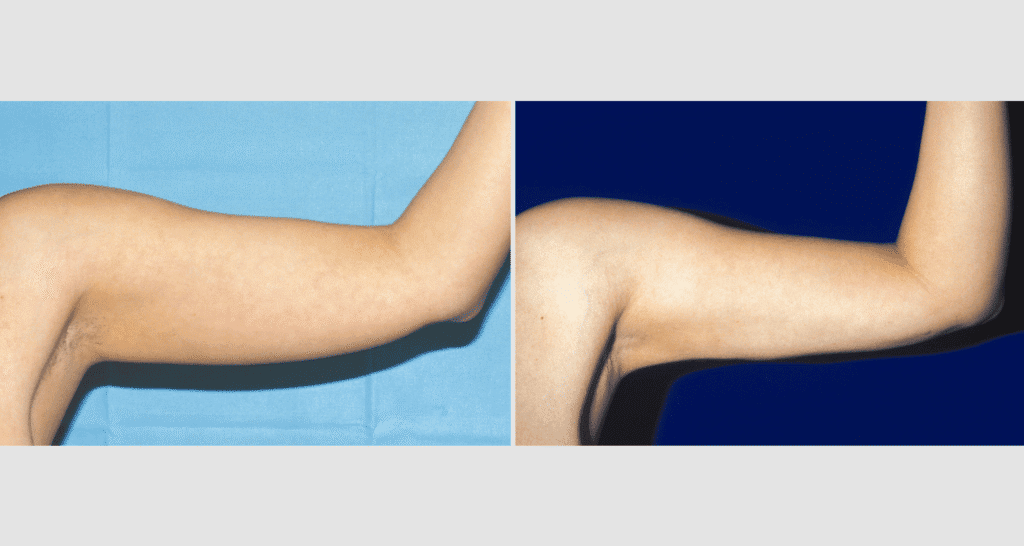 Vorher/Nachher Ergebnis: Fettabsaugung Oberarme