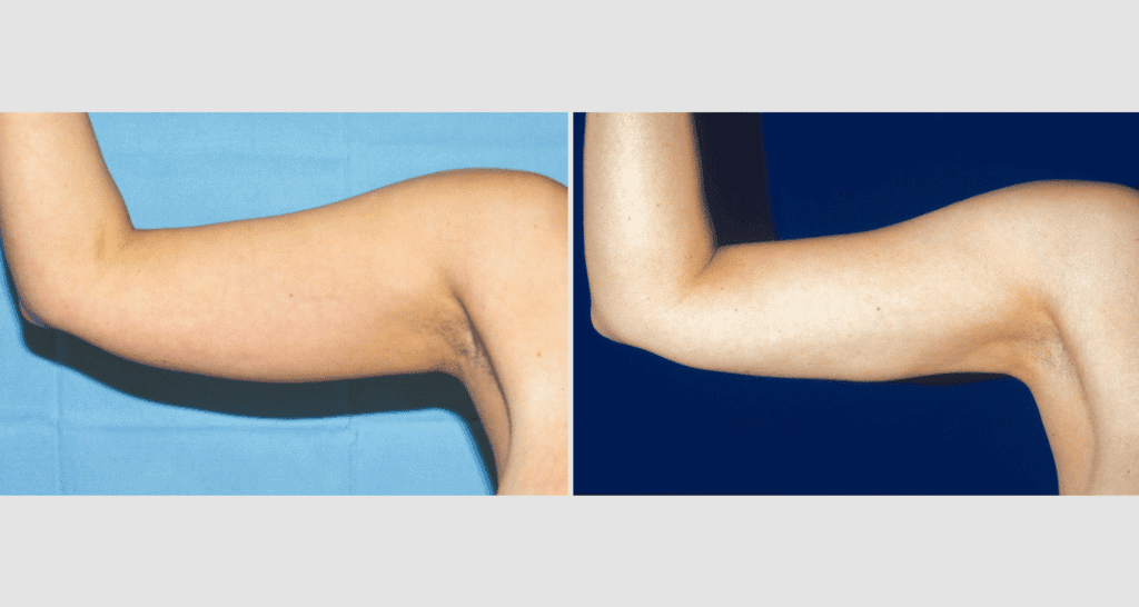Vorher/Nachher Ergebnis: Fettabsaugung Oberarme