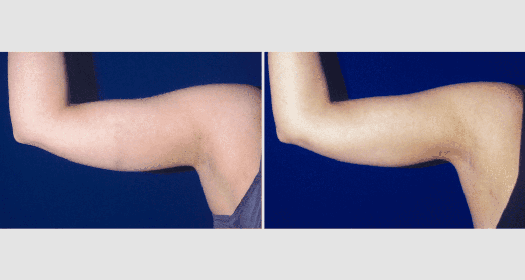 Vorher/Nachher Ergebnis: Fettabsaugung Oberarme