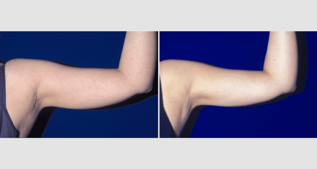 Vorher/Nachher Ergebnis: Fettabsaugung Oberarme