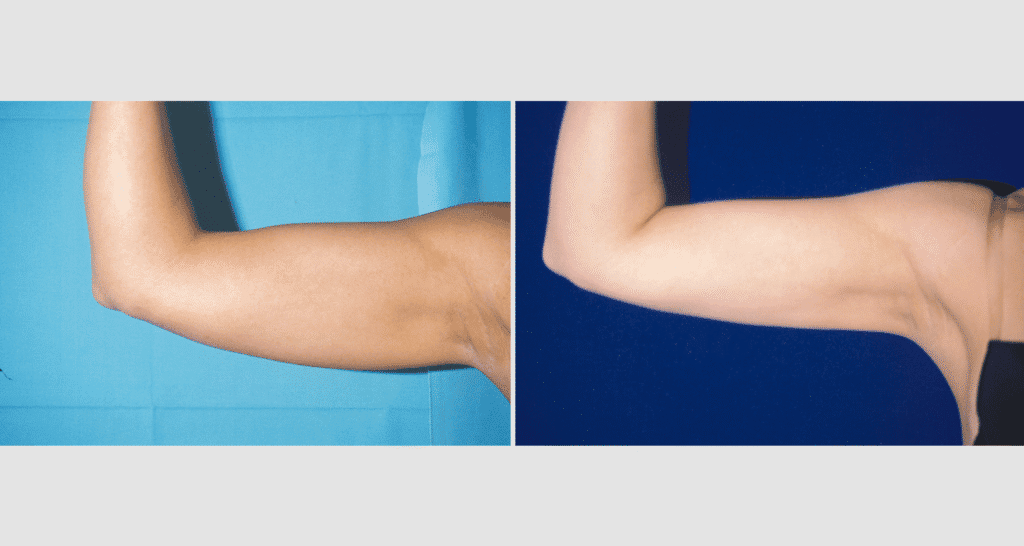 Vorher/Nachher Ergebnis: Fettabsaugung Oberarme