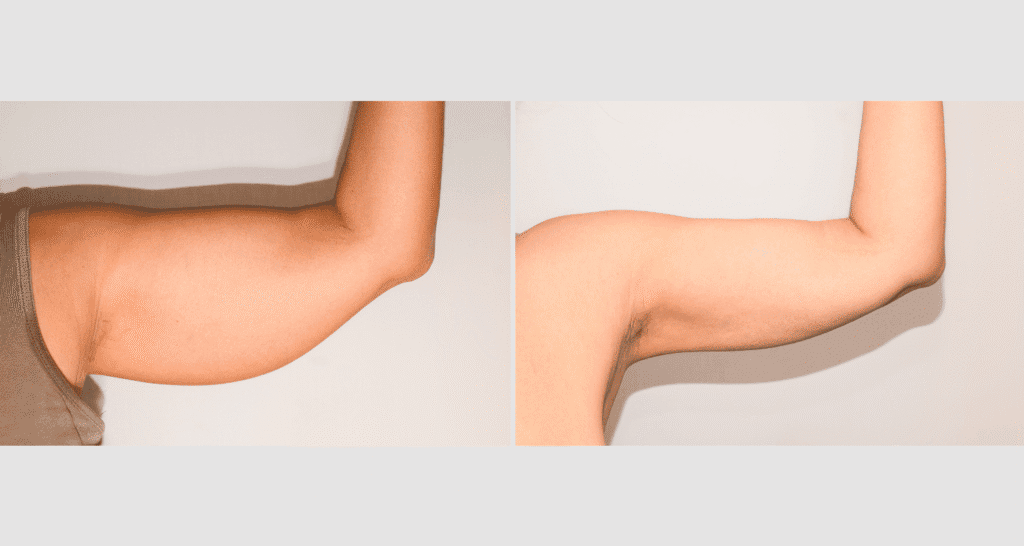 Vorher/Nachher Ergebnis: Fettabsaugung Oberarme