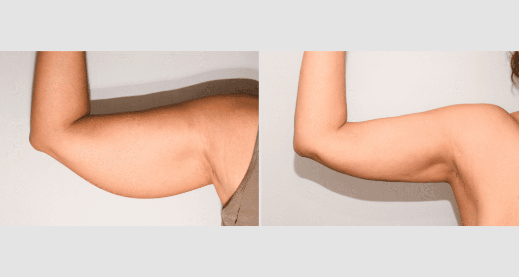 Vorher/Nachher Ergebnis: Fettabsaugung Oberarme