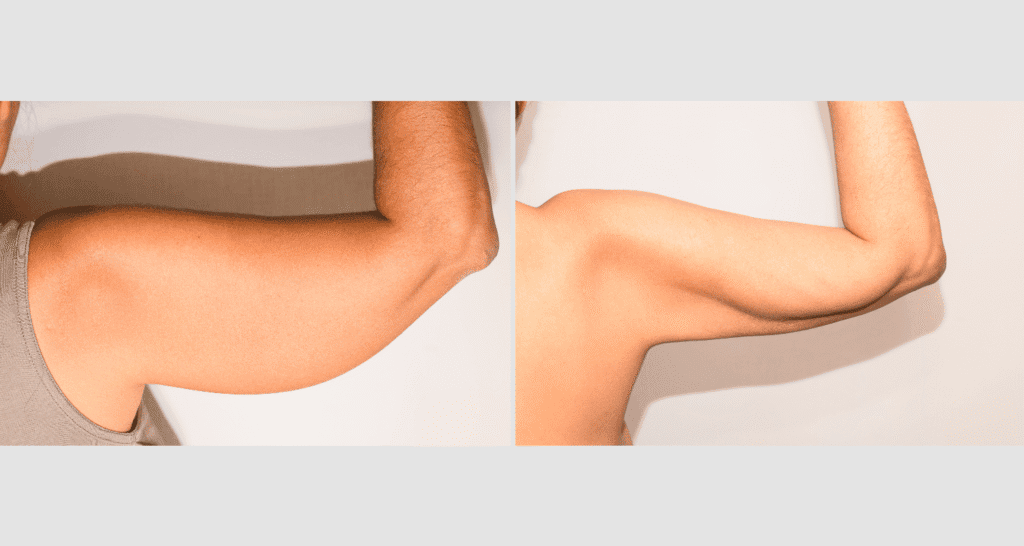 Vorher/Nachher Ergebnis: Fettabsaugung Oberarme