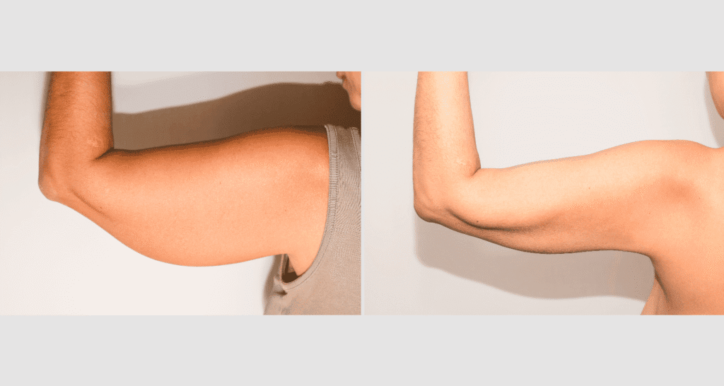 Vorher/Nachher Ergebnis: Fettabsaugung Oberarme