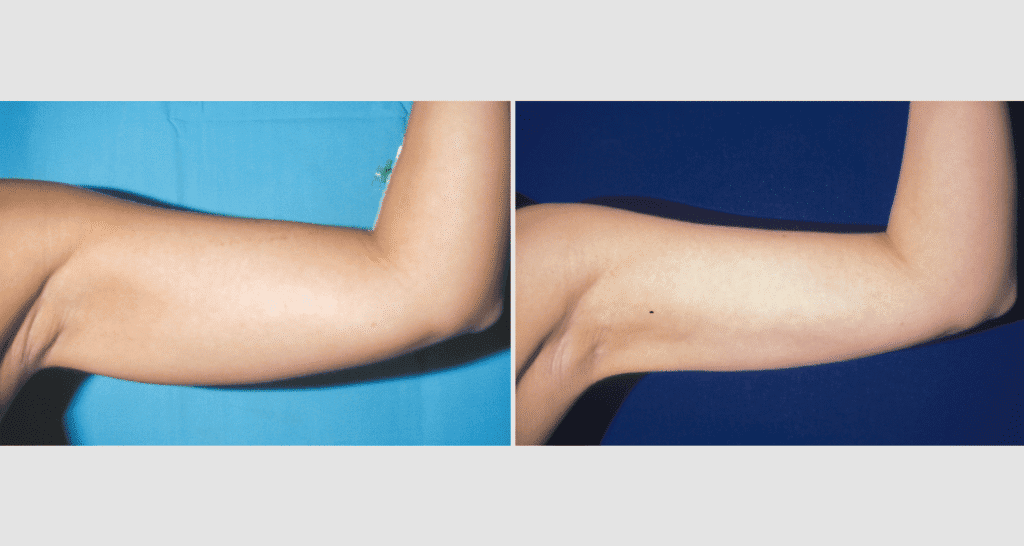 Vorher/Nachher Ergebnis: Fettabsaugung Oberarme