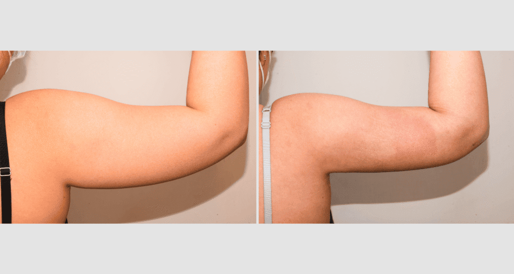 Vorher/Nachher Ergebnis: Fettabsaugung Oberarme