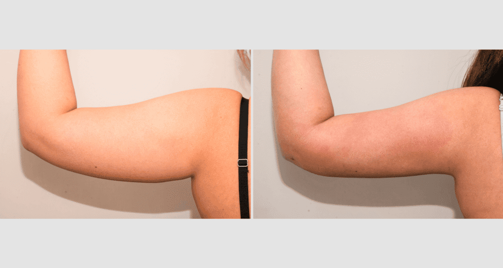 Vorher/Nachher Ergebnis: Fettabsaugung Oberarme