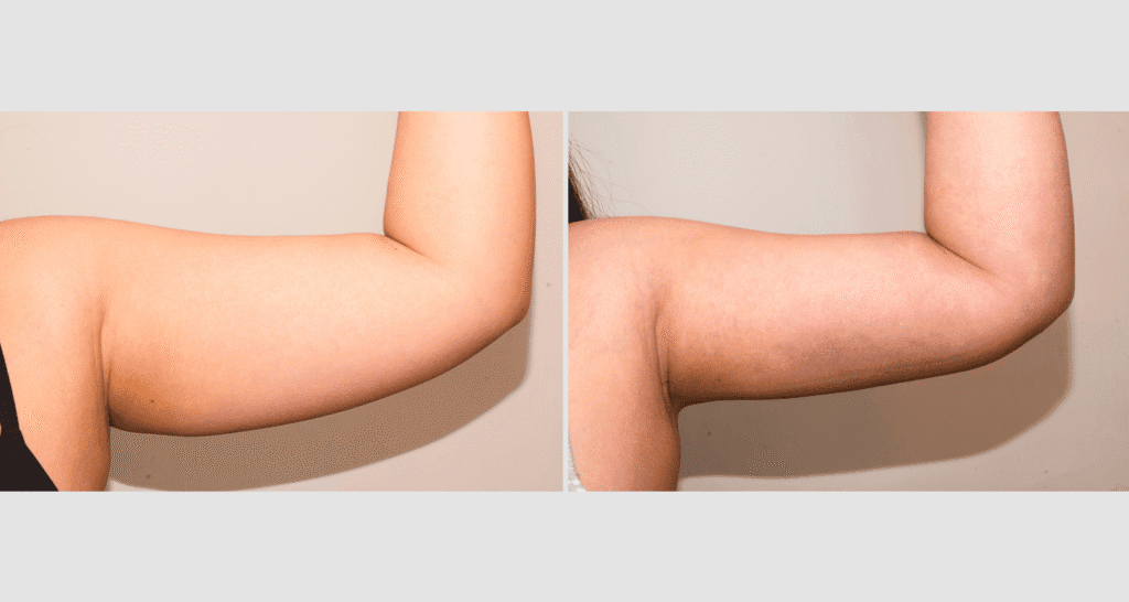 Vorher/Nachher Ergebnis: Fettabsaugung Oberarme