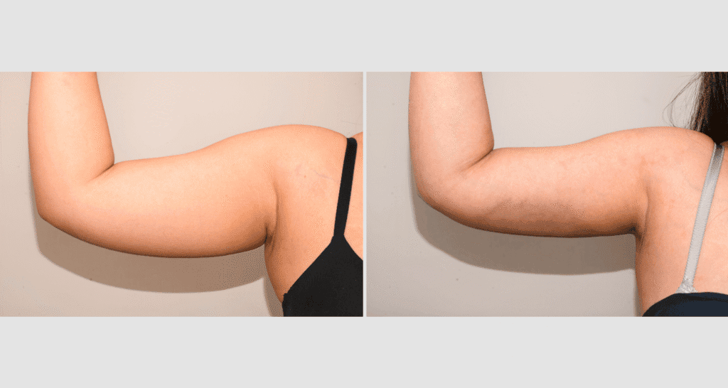 Vorher/Nachher Ergebnis: Fettabsaugung Oberarme