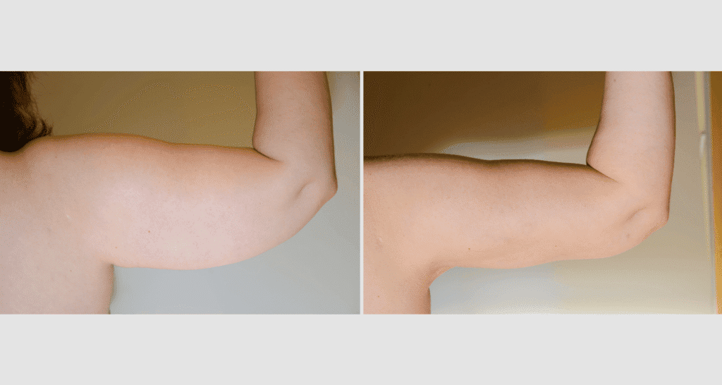 Vorher/Nachher Ergebnis: Fettabsaugung Oberarme