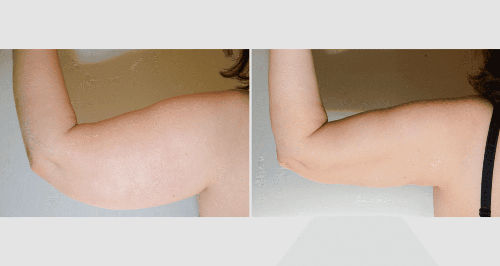Vorher/Nachher Ergebnis: Fettabsaugung Oberarme