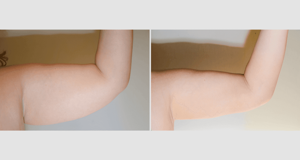 Vorher/Nachher Ergebnis: Fettabsaugung Oberarme