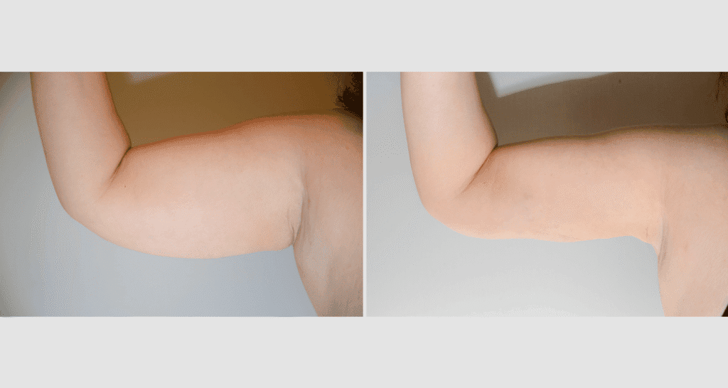 Vorher/Nachher Ergebnis: Fettabsaugung Oberarme
