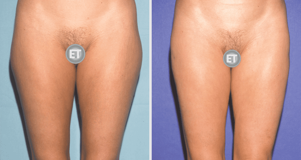 Vorher/Nachher Ergebnis: Fettabsaugung Reiterhosen