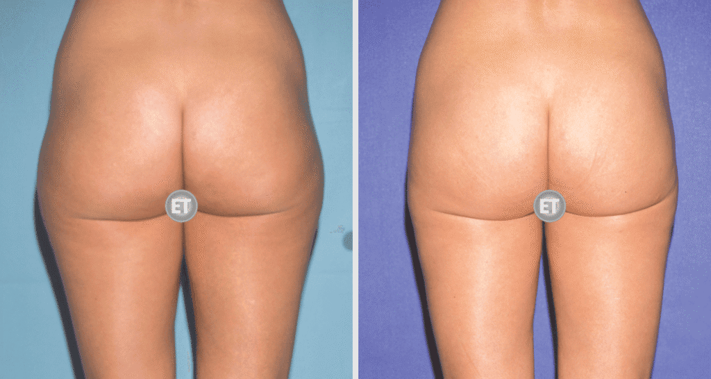 Vorher/Nachher Ergebnis: Fettabsaugung Reiterhosen