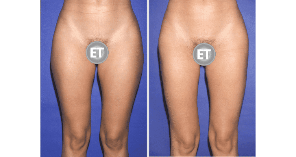 Vorher/Nachher Ergebnis: Fettabsaugung Reiterhosen