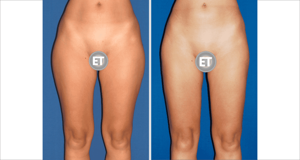 Vorher/Nachher Ergebnis: Fettabsaugung Reiterhosen