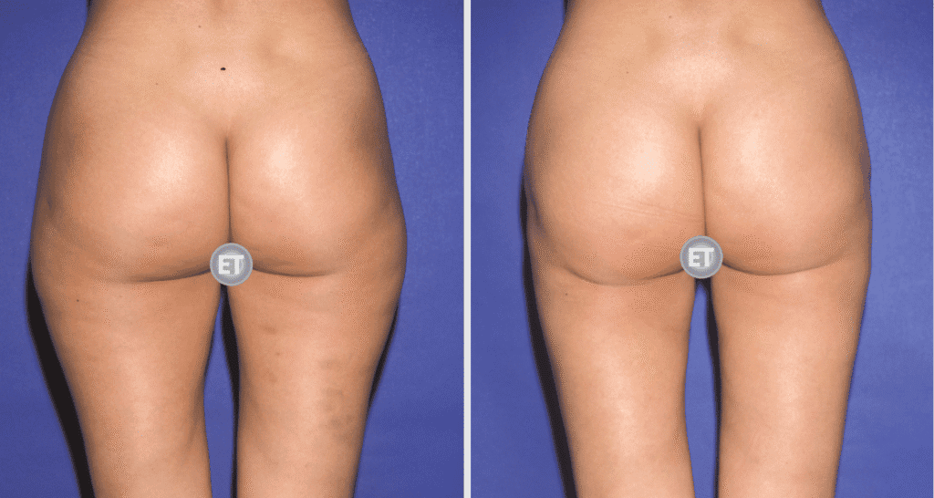 Vorher/Nachher Ergebnis: Fettabsaugung Reiterhosen