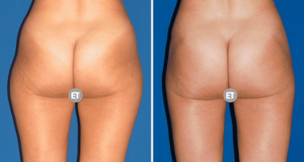 Vorher/Nachher Ergebnis: Fettabsaugung Reiterhosen