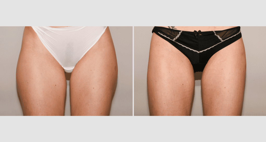 Vorher/Nachher Ergebnis: Fettabsaugung Reiterhosen
